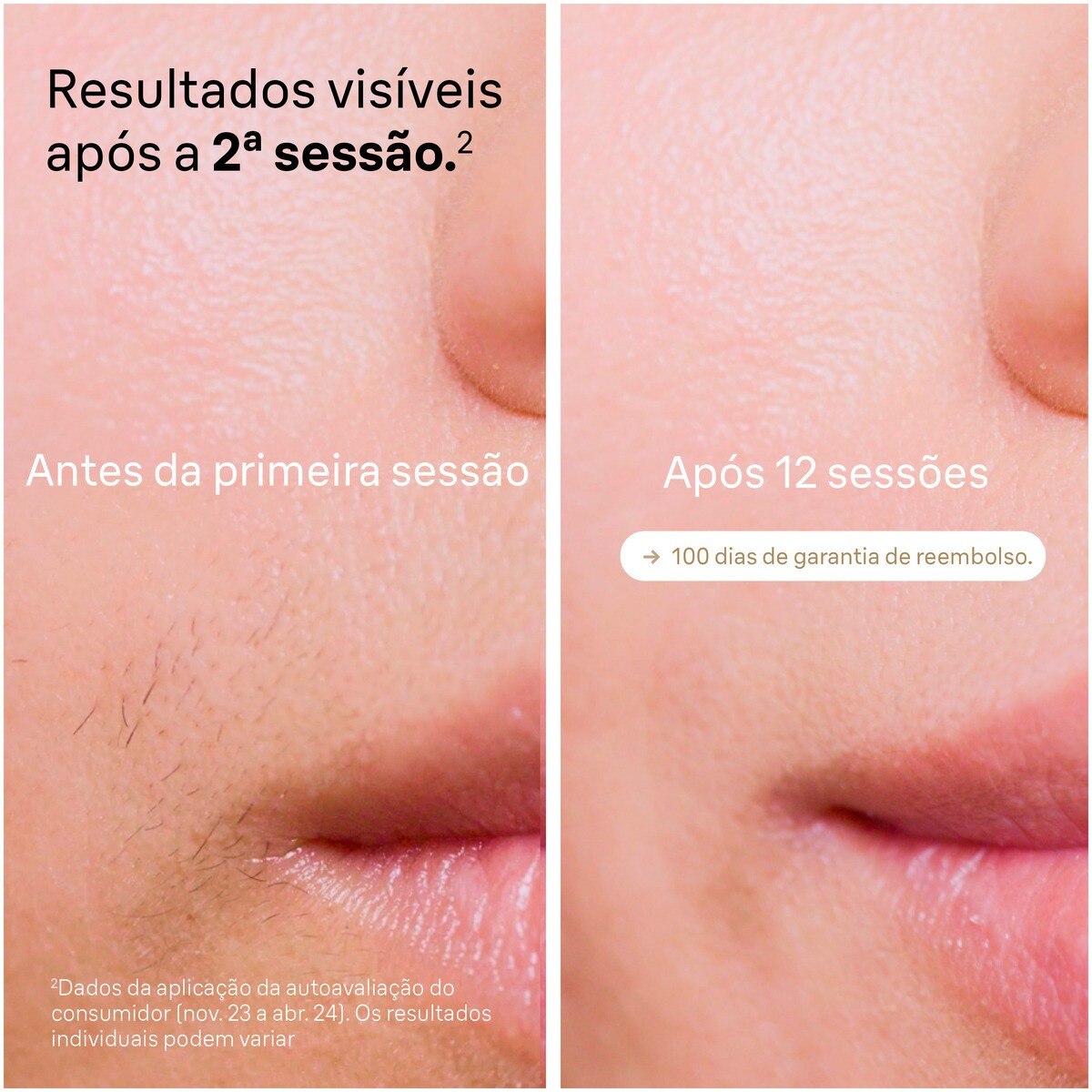 Depiladora de Luz Pulsada IPL Braun Silk Expert S5 PL5152 para Corpo e Rosto - Branco e Dourado Branco / Dourado-3