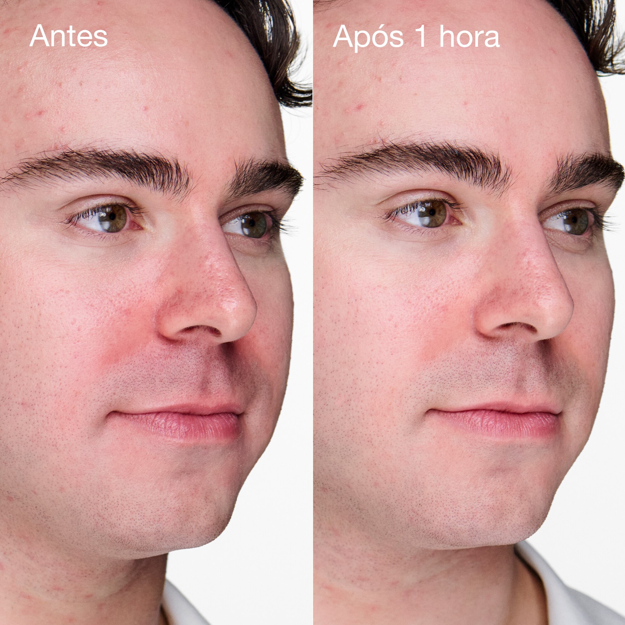 Anti-Blemish Solutions Clinical™ Advanced Clearing Gel 3