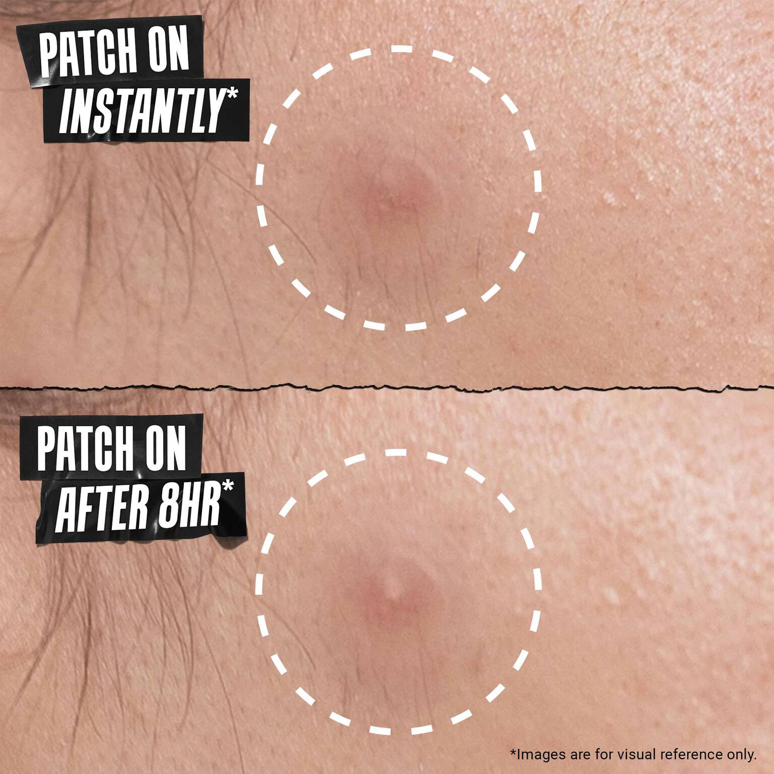Truly Targeted Overnight Blemish Patch 5
