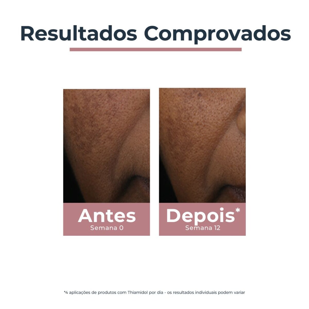 Corretor Localizado de Manchas Anti-Pigment - 5 ml 6