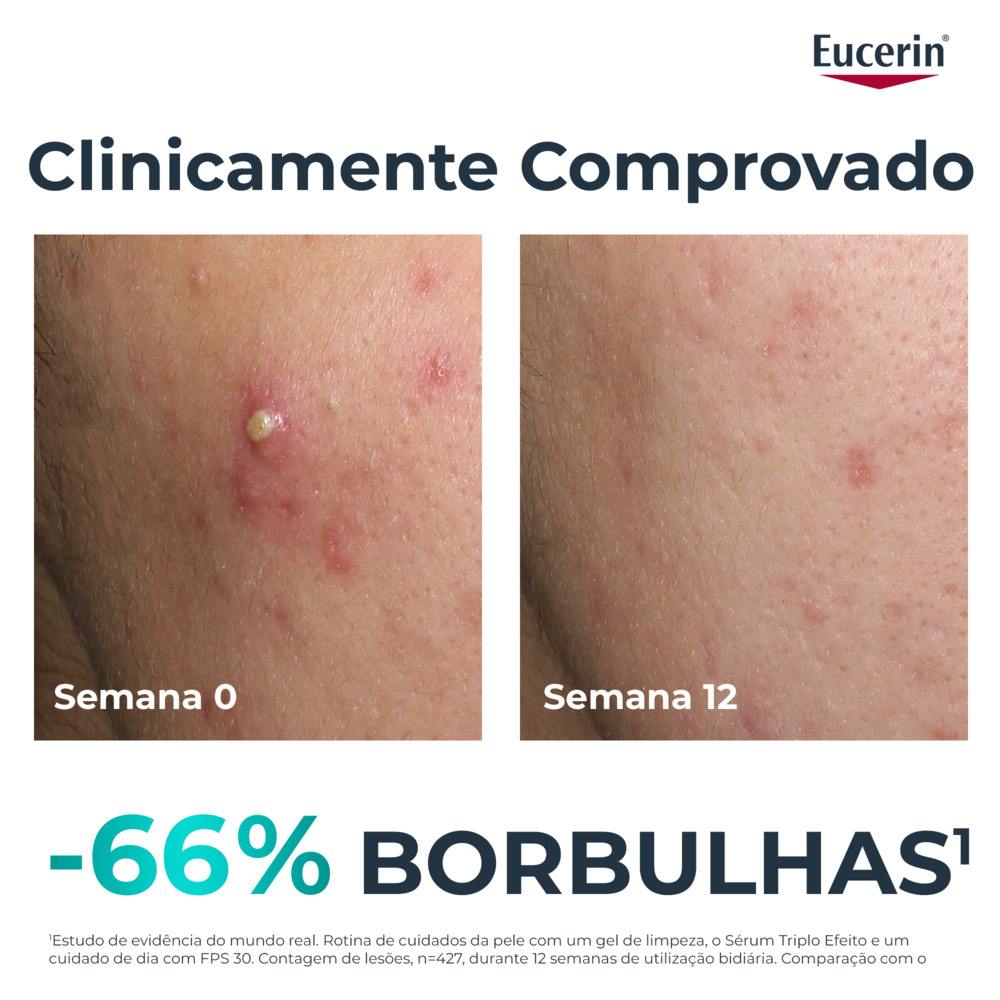 Sérum Triplo Efeito DermoPure Antimarcas Pós-Acne Pele Oleosa 2