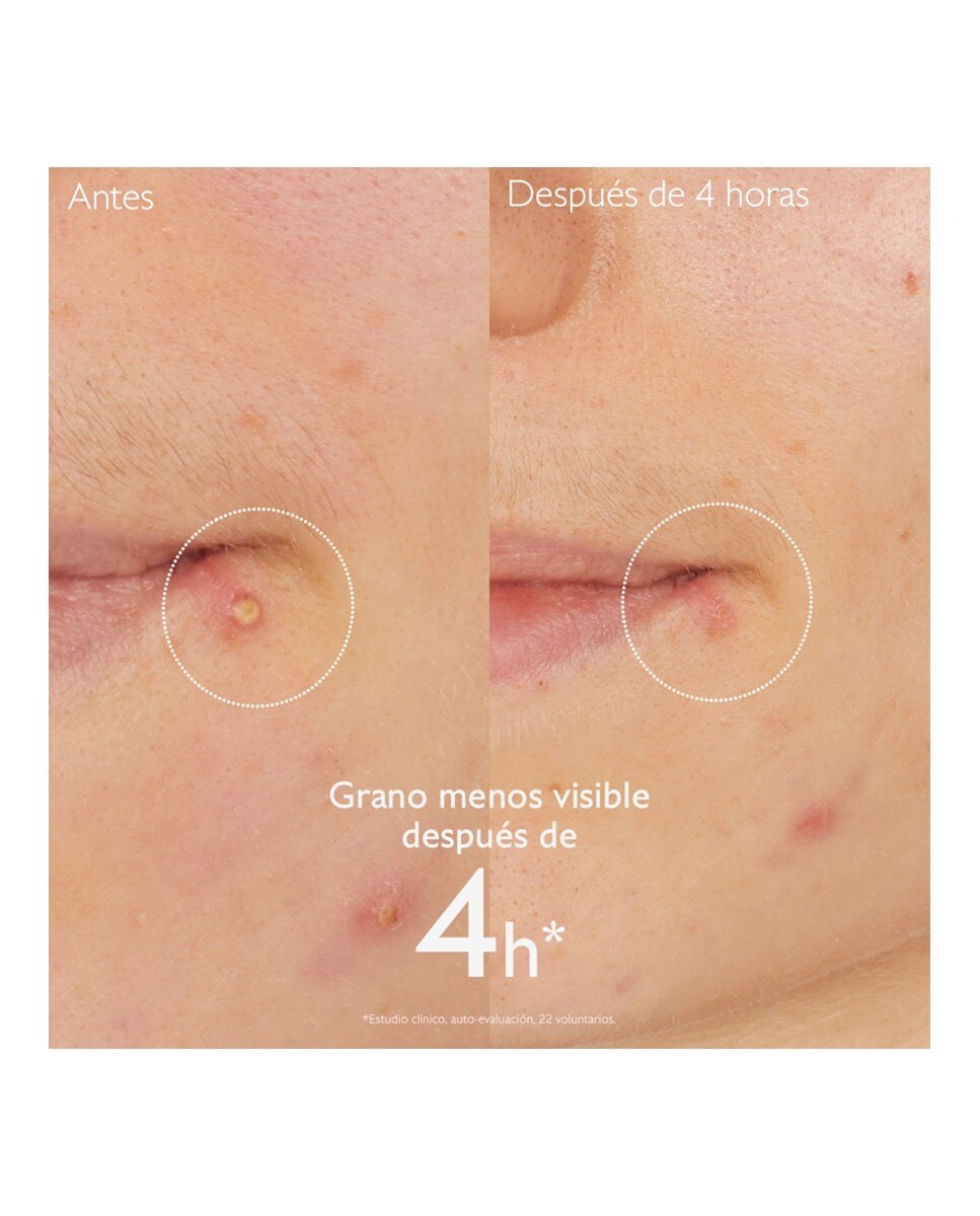 Stop Borbulhas Salicílico Vinopure 3