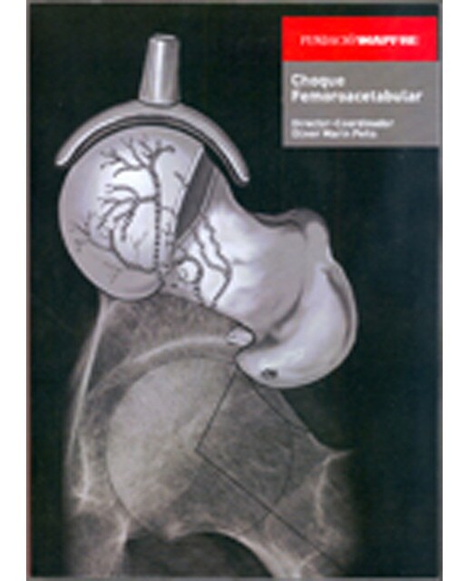 Choque femoracetabular