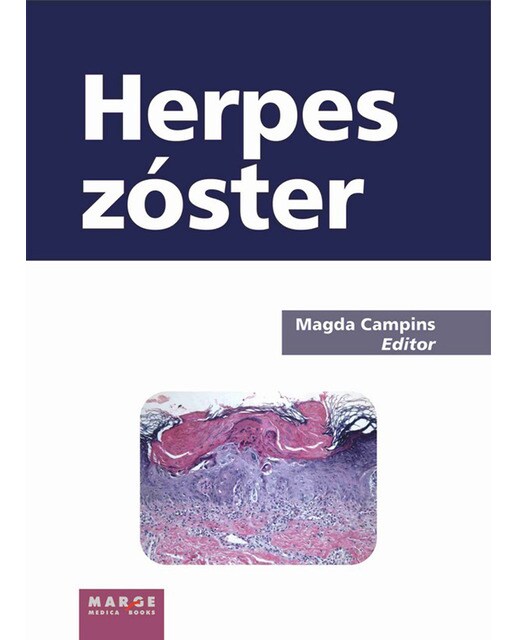 Herpes zóster