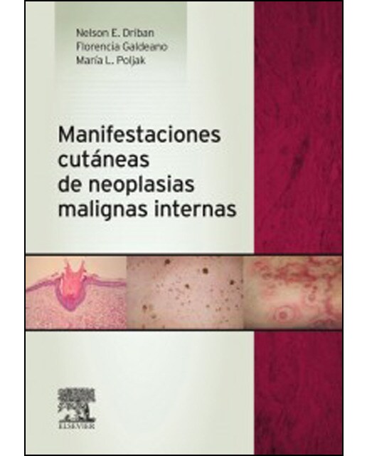 Manifestaciones cutáneas de neoplasias malignas internas
