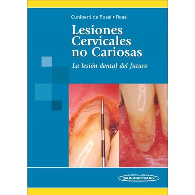 Lesiones Cervicales no Cariosa: La lesión dental del futuro 1