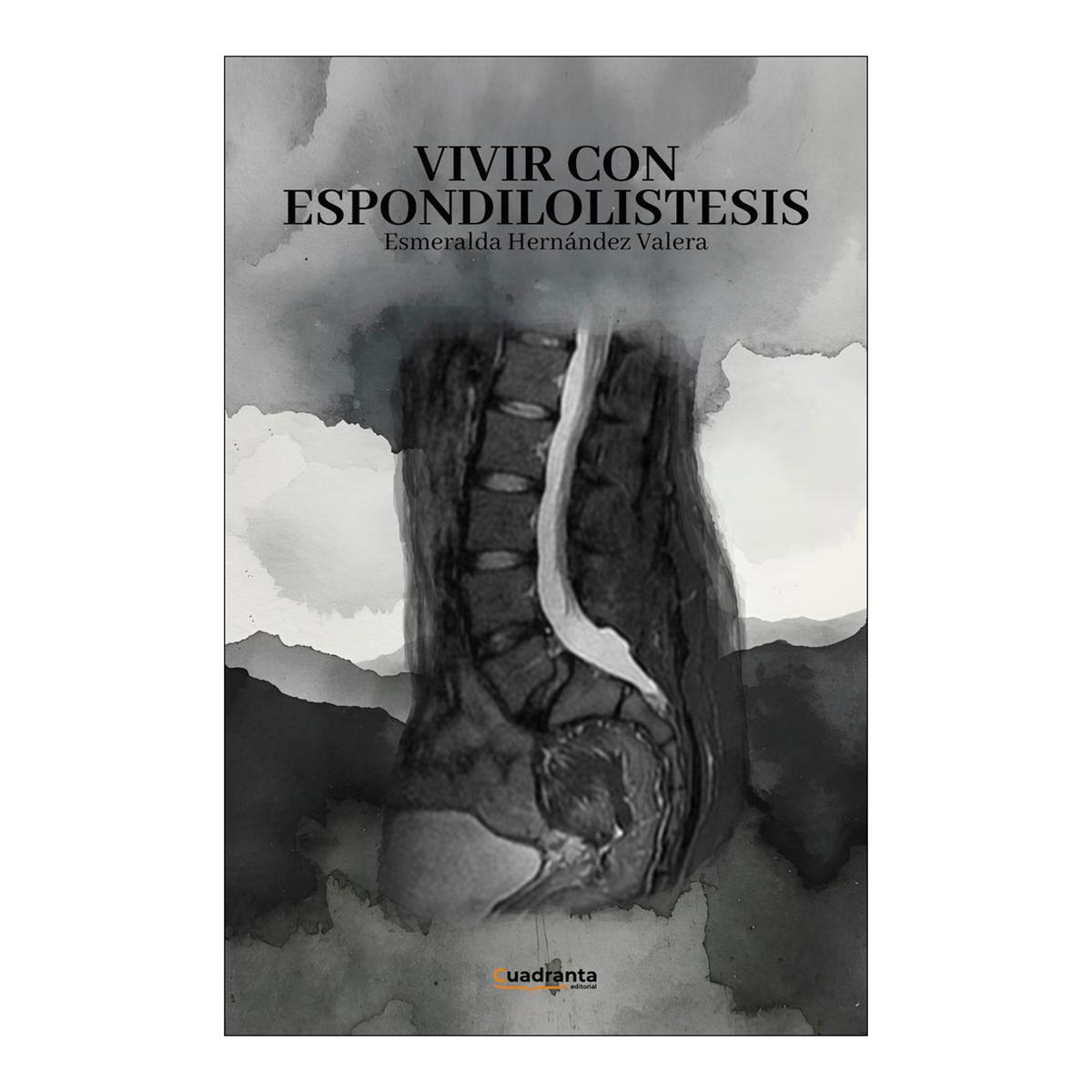 Vivir con espondilolistesis 1