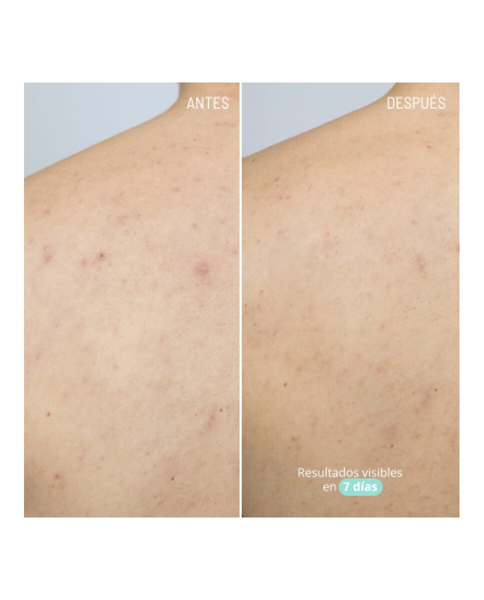 Gel Azelaic Active Body Treatment Freshly Cosmetics - 100 ml 3