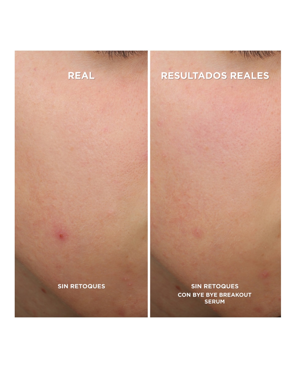 Sérum Bye Bye Breakout It Cosmetics 4