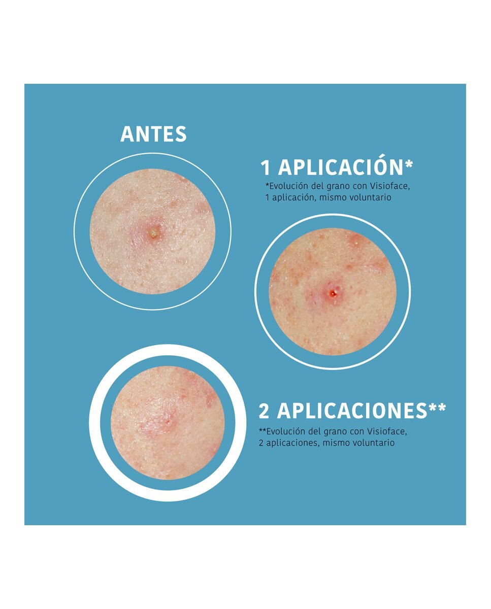 Imagen 5 de 15 Parches SOS Granos con Ácido Salicílico DC Pharm - 25 g