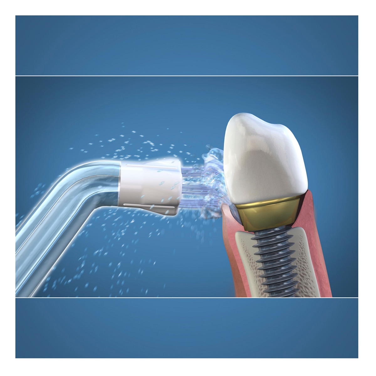 Imagen 2 de 2 Boquillas Seeker® para placa inaccesible Waterpik
