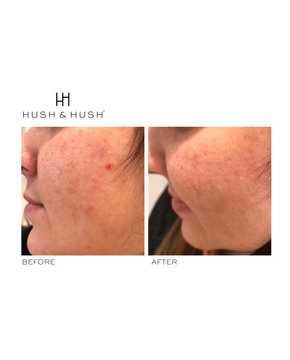 60 Cápsulas SkinCapsule Clear+Fórmula Antiacné Hush&Hush 4