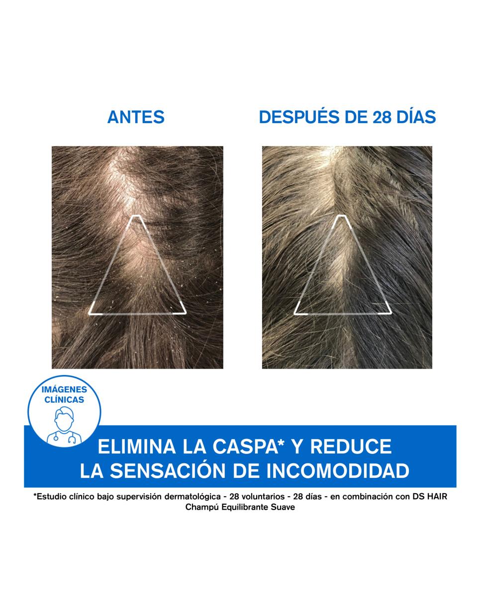 Hair Champú Tratante Anticaspa HS 200 ml Uriage - 200 ml 5