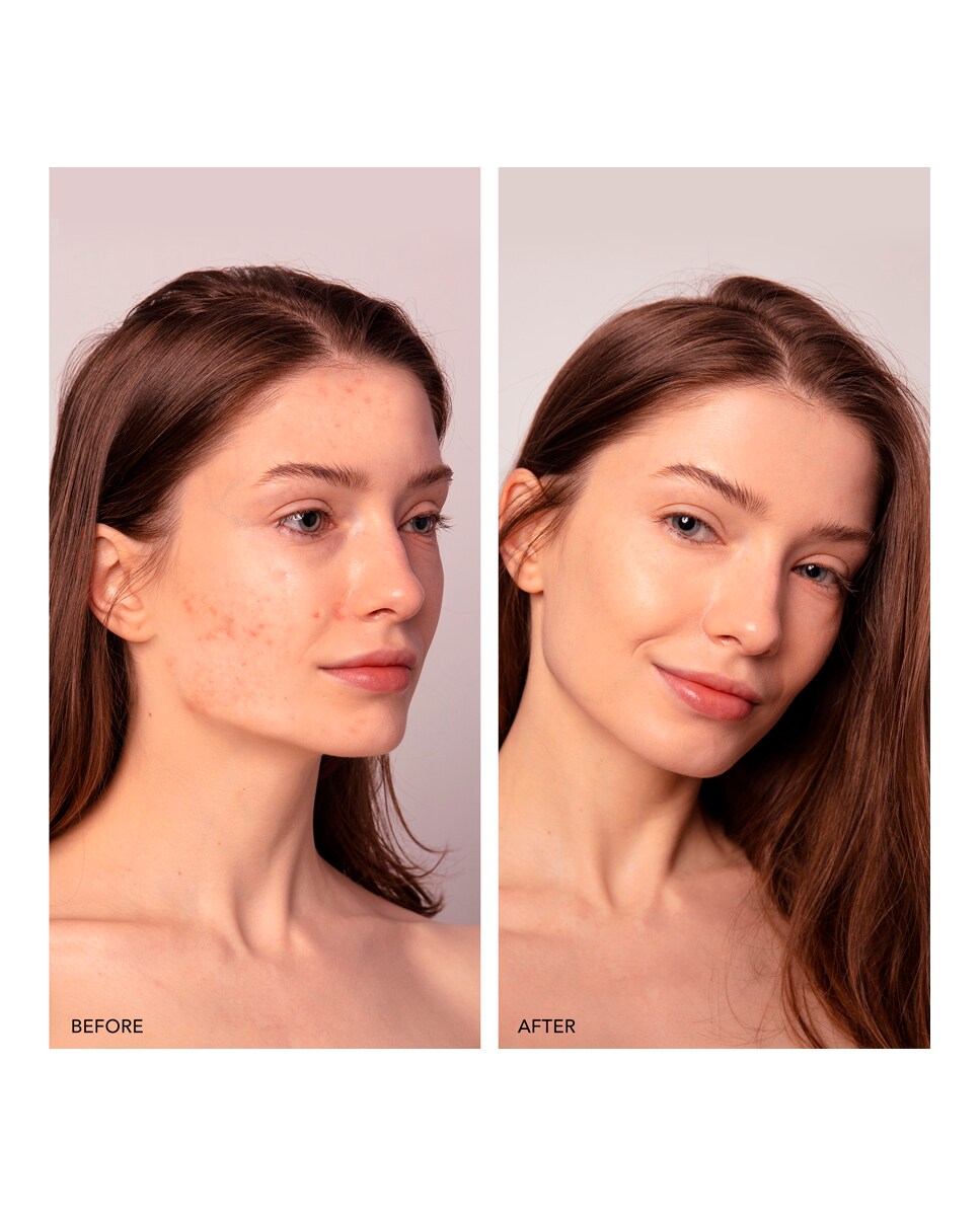 Manchas Luz Pulsada Intensa Fotorejuvenecimiento Facial Hedonai